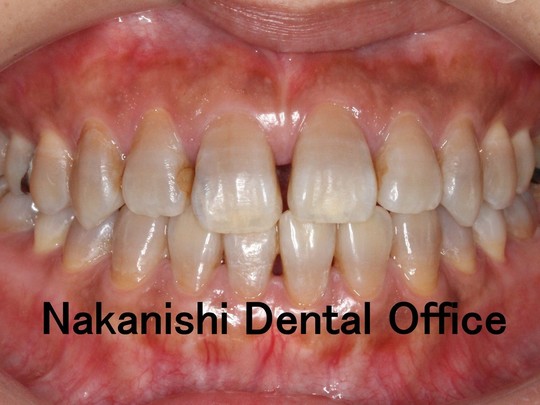 審美歯科治療 - NAKANISHI DENTAL OFFICE（兵庫県芦屋市）