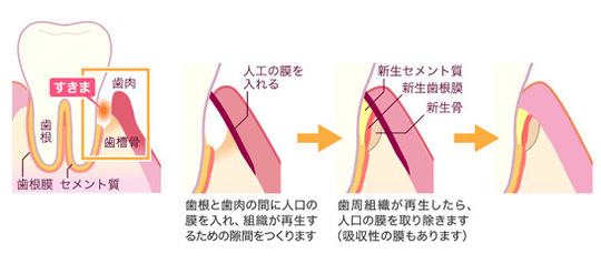 歯周病の治療 - NAKANISHI DENTAL OFFICE（兵庫県芦屋市）